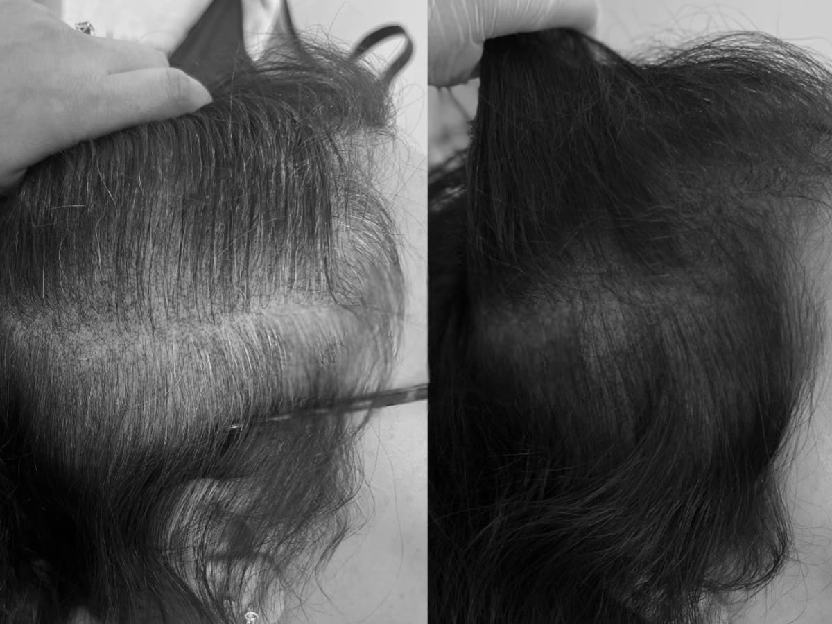 Parting before and after treatment for androgenetic alopecia: marked thinning, then new growth with better scalp coverage, black-and-white photograph