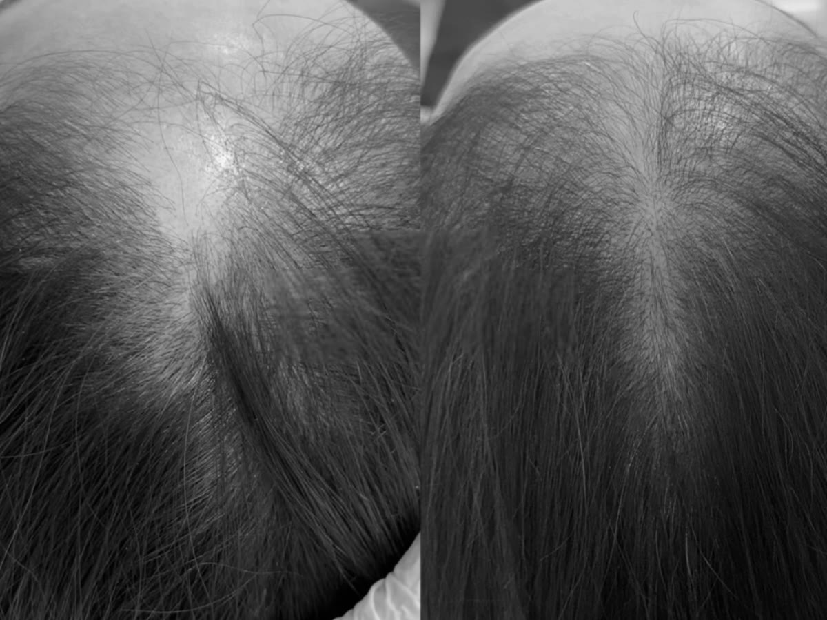 Crown seen from above before and after treatment for androgenetic alopecia: marked thinning, then new growth with better scalp coverage, black-and-white photograph