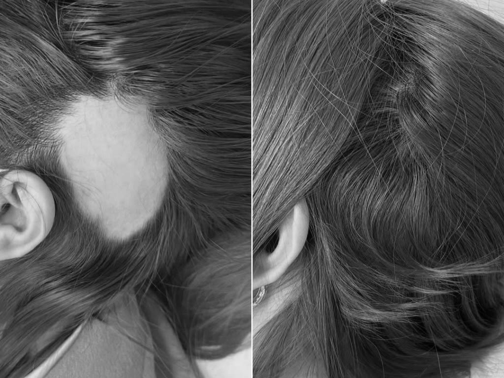 Temple area before and after treatment for alopecia areata: a bald patch, then complete regrowth after 7 months, black-and-white photograph