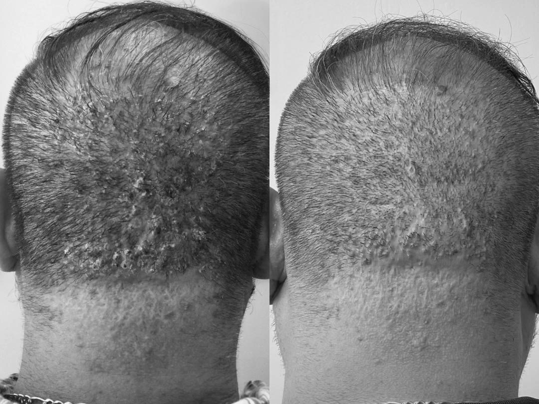Back of the head before and after treatment for folliculitis decalvans: multiple pustules, crusting and redness, then markedly reduced inflammation after 8 weeks, black-and-white photograph