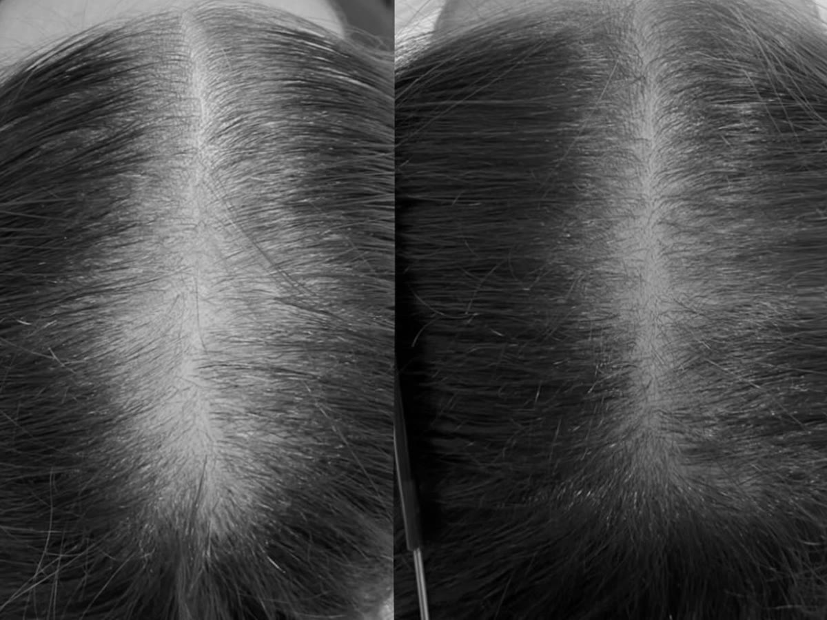 Centre parting before and after treatment for female pattern hair loss: a widened parting, then improved hair density, black-and-white photograph