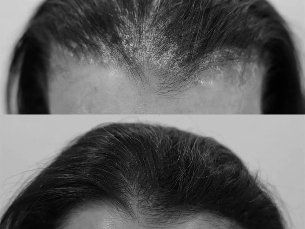 Frontal hairline before and after treatment: scaling and crusting above, clear skin with new hair growth below, black-and-white photograph
