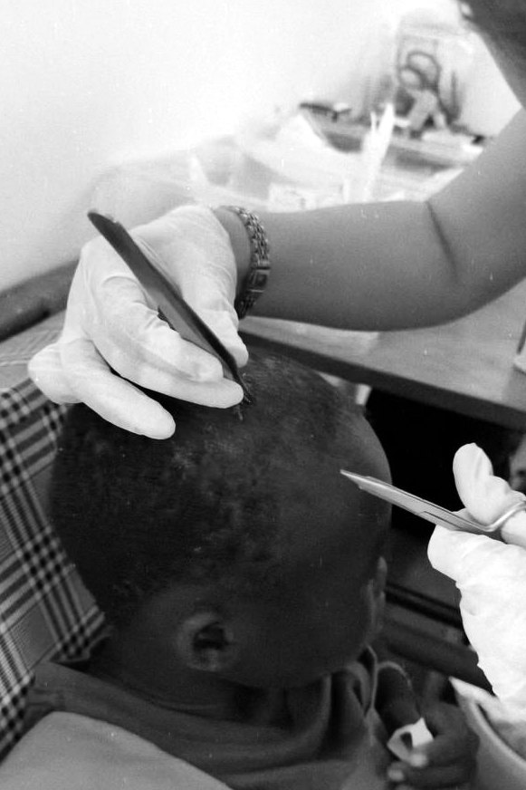 A doctor removing sutures from a child’s head, black-and-white photograph